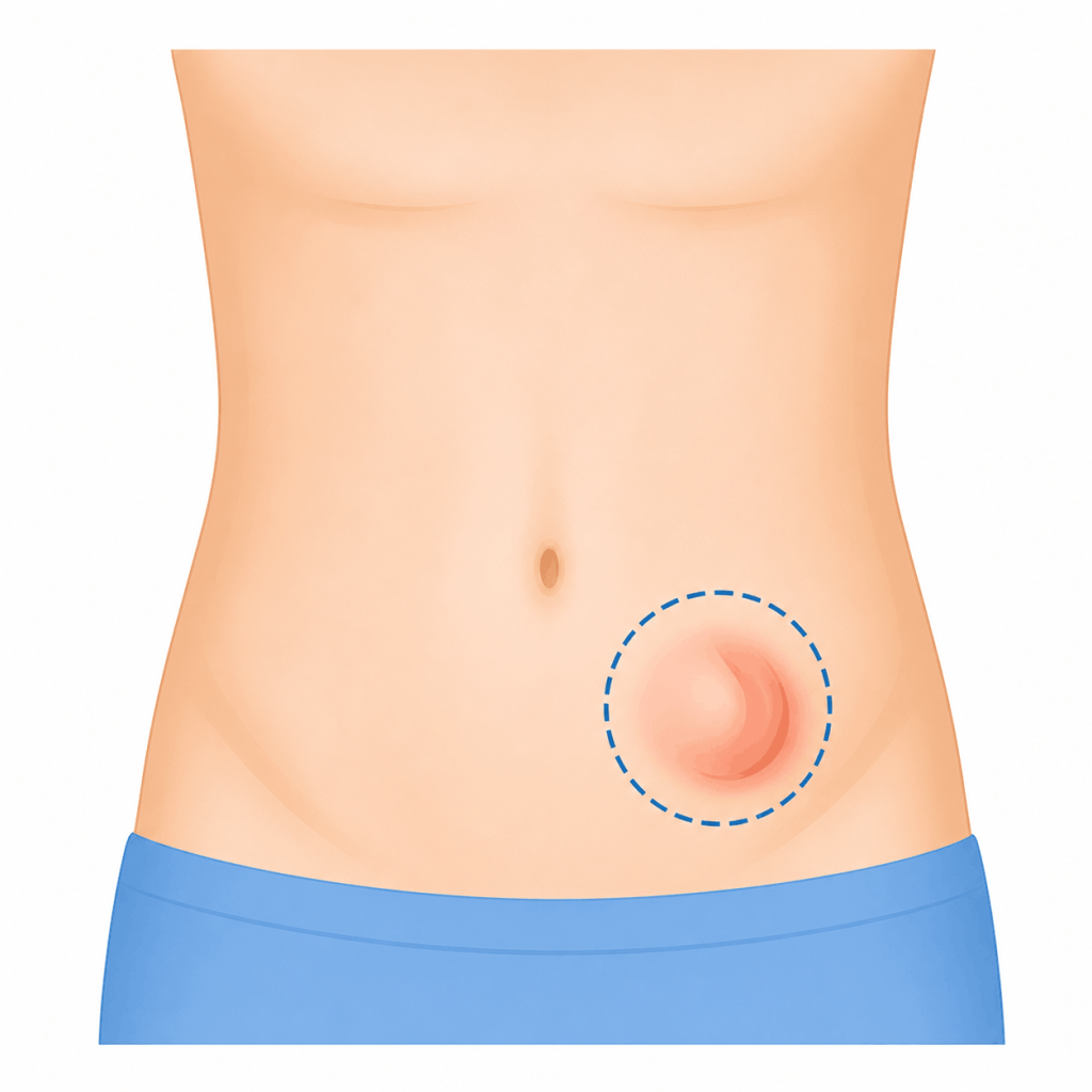 MIRA Healthcare -hernia-image1