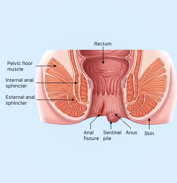 Fissure Treatment - Mira Healthcare