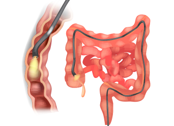 Colonoscopy Recommended - Mira Healthcare