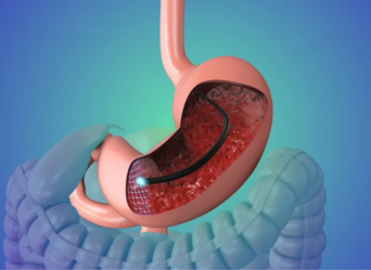 Endoscopy Recommended - Mira Healthcare